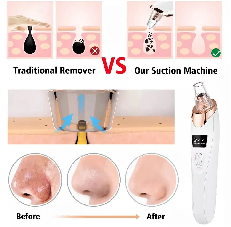 Rechargeable Blackhead Remover